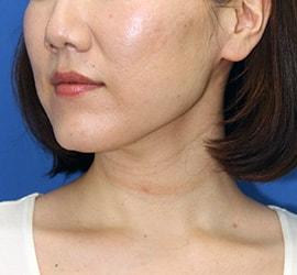 30代女性のシワ・たるみ After 症例写真