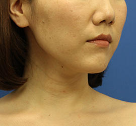 30代女性の顔の脂肪吸引  After 症例写真