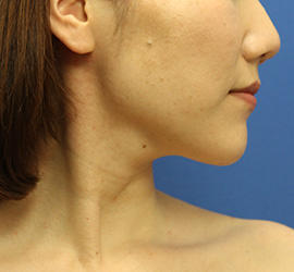 30代女性の顔の脂肪吸引  After 症例写真