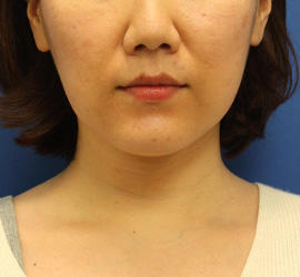 30代女性の顔の脂肪吸引  Before 症例写真