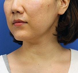 30代女性のシワ・たるみ Before 症例写真