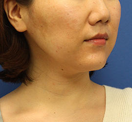 30代女性の顔の脂肪吸引  Before 症例写真