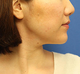 30代女性の顔の脂肪吸引  Before 症例写真