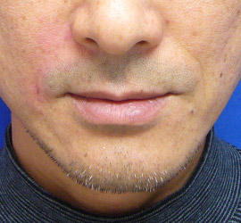 50代男性のシワ・たるみ After 症例写真