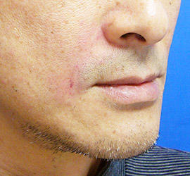 50代男性のヒアルロン酸注射  After 症例写真