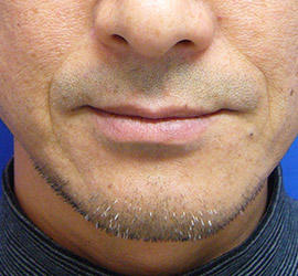 50代男性のシワ・たるみ Before 症例写真