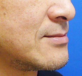 50代男性のヒアルロン酸注射  Before 症例写真