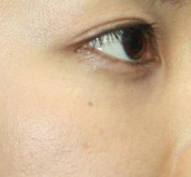 20代女性の目の下のクマ治療 After 症例写真