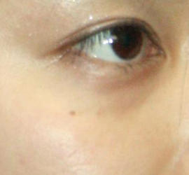 20代女性の目の下のクマ治療 Before 症例写真