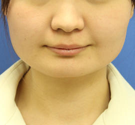20代女性のボトックス(小顔) Before 症例写真