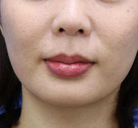 20代女性の唇・口元の整形 Before 症例写真