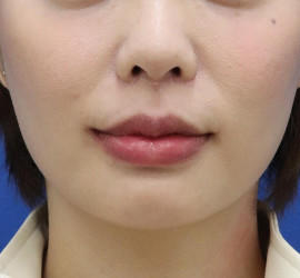 20代女性の唇・口元の整形 After 症例写真