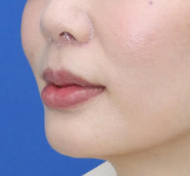 20代女性の人中短縮（リップリフト） After 症例写真