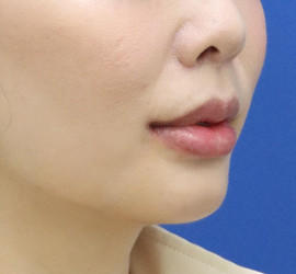 20代女性の人中短縮（リップリフト） After 症例写真