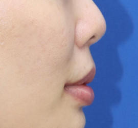 20代女性の人中短縮（リップリフト） After 症例写真
