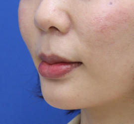 20代女性の人中短縮（リップリフト） Before 症例写真