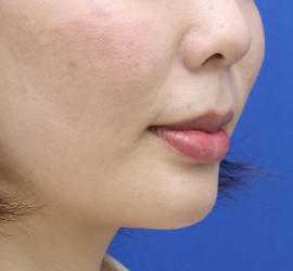 20代女性の人中短縮（リップリフト） Before 症例写真