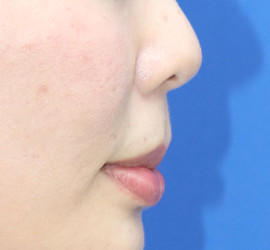 20代女性の人中短縮（リップリフト） Before 症例写真