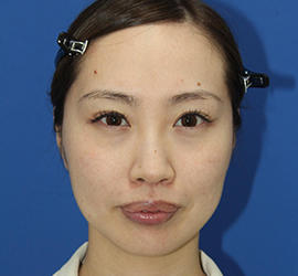 30代女性のダブロ ゴールド After 症例写真