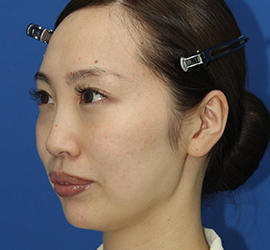 30代女性のダブロ ゴールド After 症例写真