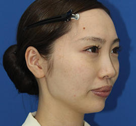 30代女性のダブロ ゴールド After 症例写真