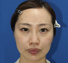 30代女性のダブロ ゴールド Before 症例写真