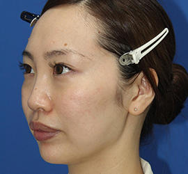 30代女性のダブロ ゴールド Before 症例写真