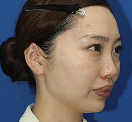 30代女性のダブロ ゴールド Before 症例写真