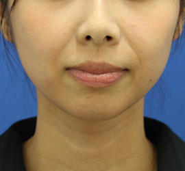 30代女性のバッカルファット除去 After 症例写真