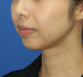 30代女性のバッカルファット除去 After 症例写真