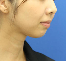 30代女性のシワ・たるみ After 症例写真