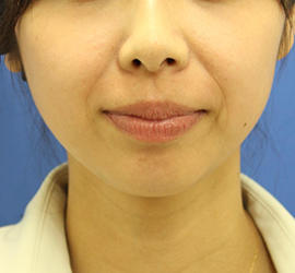 30代女性のバッカルファット除去 Before 症例写真