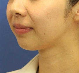 30代女性のバッカルファット除去 Before 症例写真