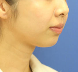 30代女性のシワ・たるみ Before 症例写真