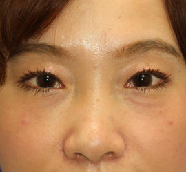 30代女性のヒアルロン酸注射（目の下） After 症例写真