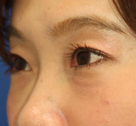 30代女性のヒアルロン酸注射(目の下) After 症例写真