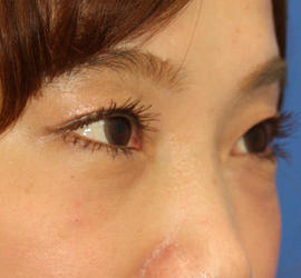 30代女性のヒアルロン酸注射（目の下） After 症例写真