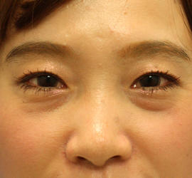 30代女性のヒアルロン酸注射（目の下） Before 症例写真