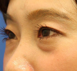 30代女性のヒアルロン酸注射(目の下) Before 症例写真