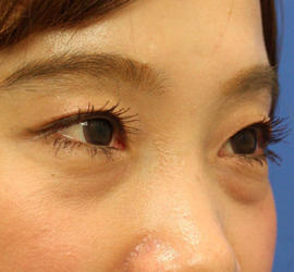 30代女性のヒアルロン酸注射（目の下） Before 症例写真