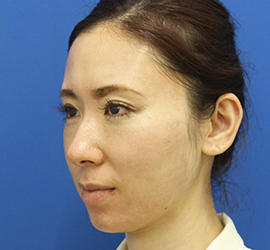 30代女性のダブロ ゴールド After 症例写真