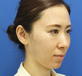 30代女性のダブロ ゴールド After 症例写真