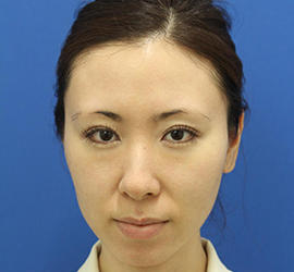 30代女性のダブロ ゴールド Before 症例写真