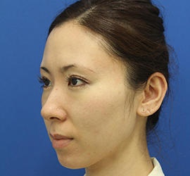 30代女性のダブロ ゴールド Before 症例写真