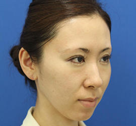 30代女性のダブロ ゴールド Before 症例写真