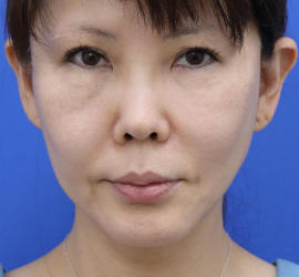 50代女性の顔の脂肪吸引  After 症例写真