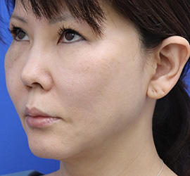 50代女性のシワ・たるみ After 症例写真