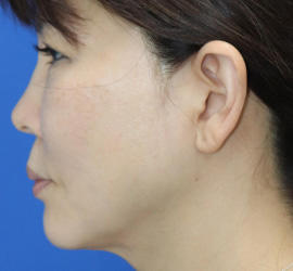 50代女性の顔の脂肪吸引  After 症例写真