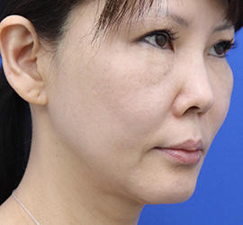 50代女性の顔の脂肪吸引  After 症例写真