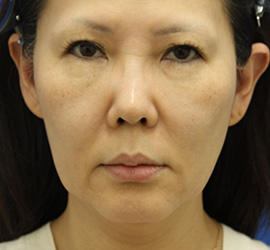 50代女性の顔の脂肪吸引  Before 症例写真